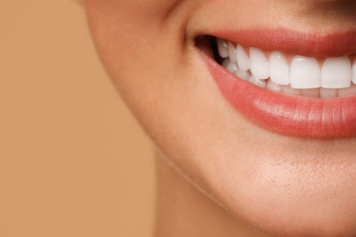 veneers